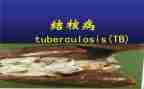 2024.3.24结核病宣传总结5篇